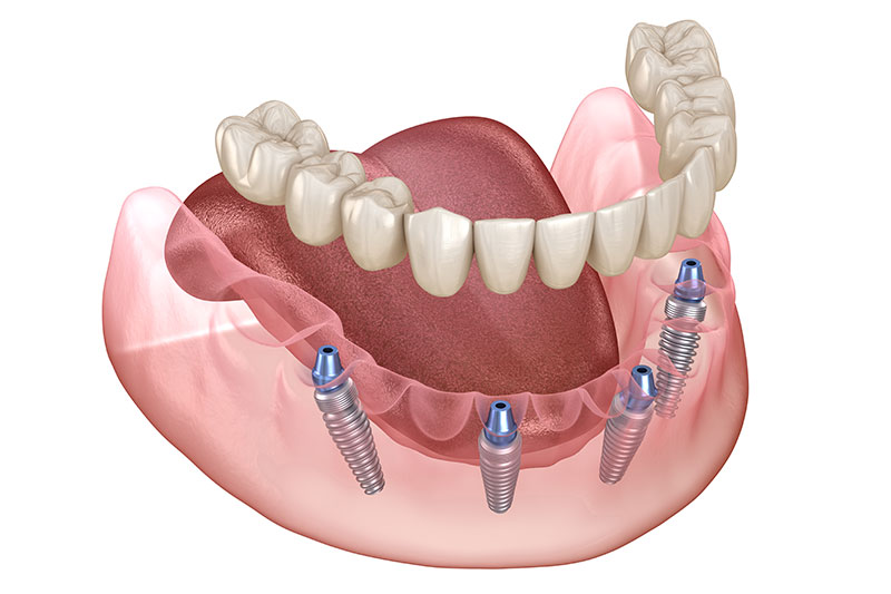 All on 4 Dental Implants in Spokane