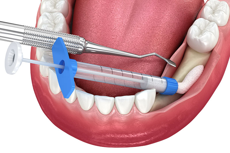Bone Grafting in Spokane