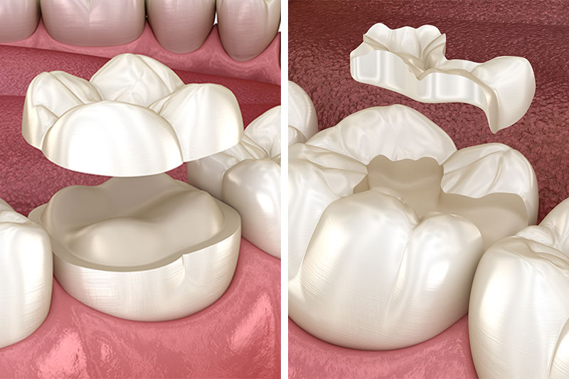 Dental Inlays and Onlays in Spokane