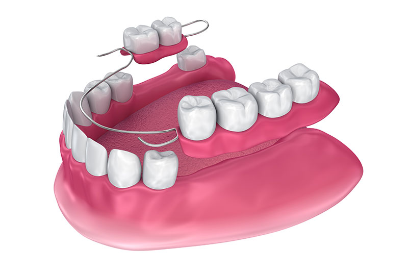 Partial Dentures in Spokane