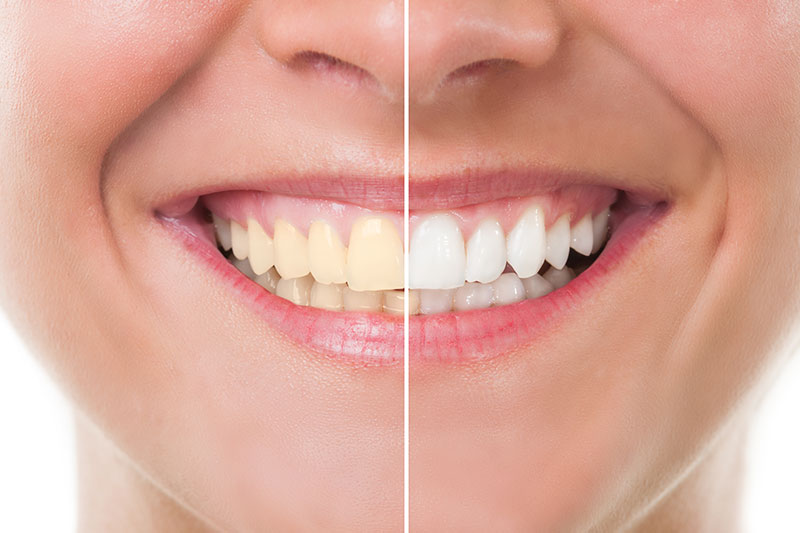 Teeth Whitening in Spokane