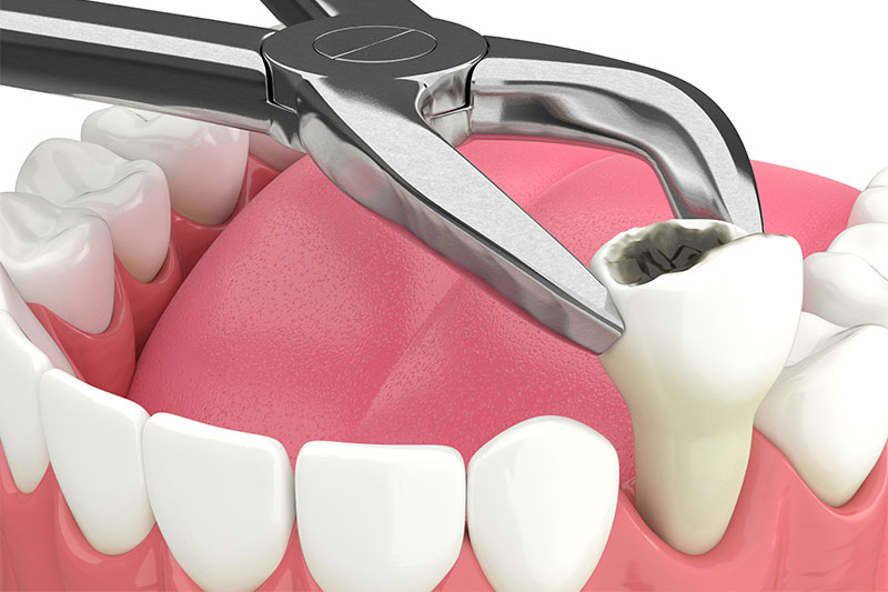 Tooth Extractions in Spokane